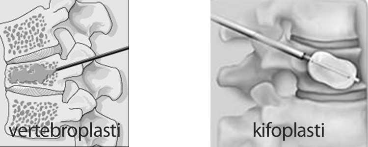 Vertebroplasti - Kifoplasti