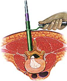 lumbar mıcrodıscectomy