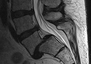 Spondylolisthesis Treatment