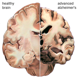 Alzheimer Hastalığı Kimlerde Görülür