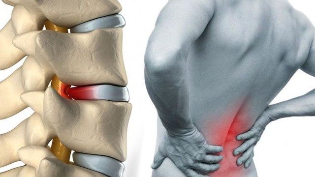 Bel fıtığı başlangıcı