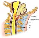 Beyincik Sarkması (Chiari Malformasyonu)