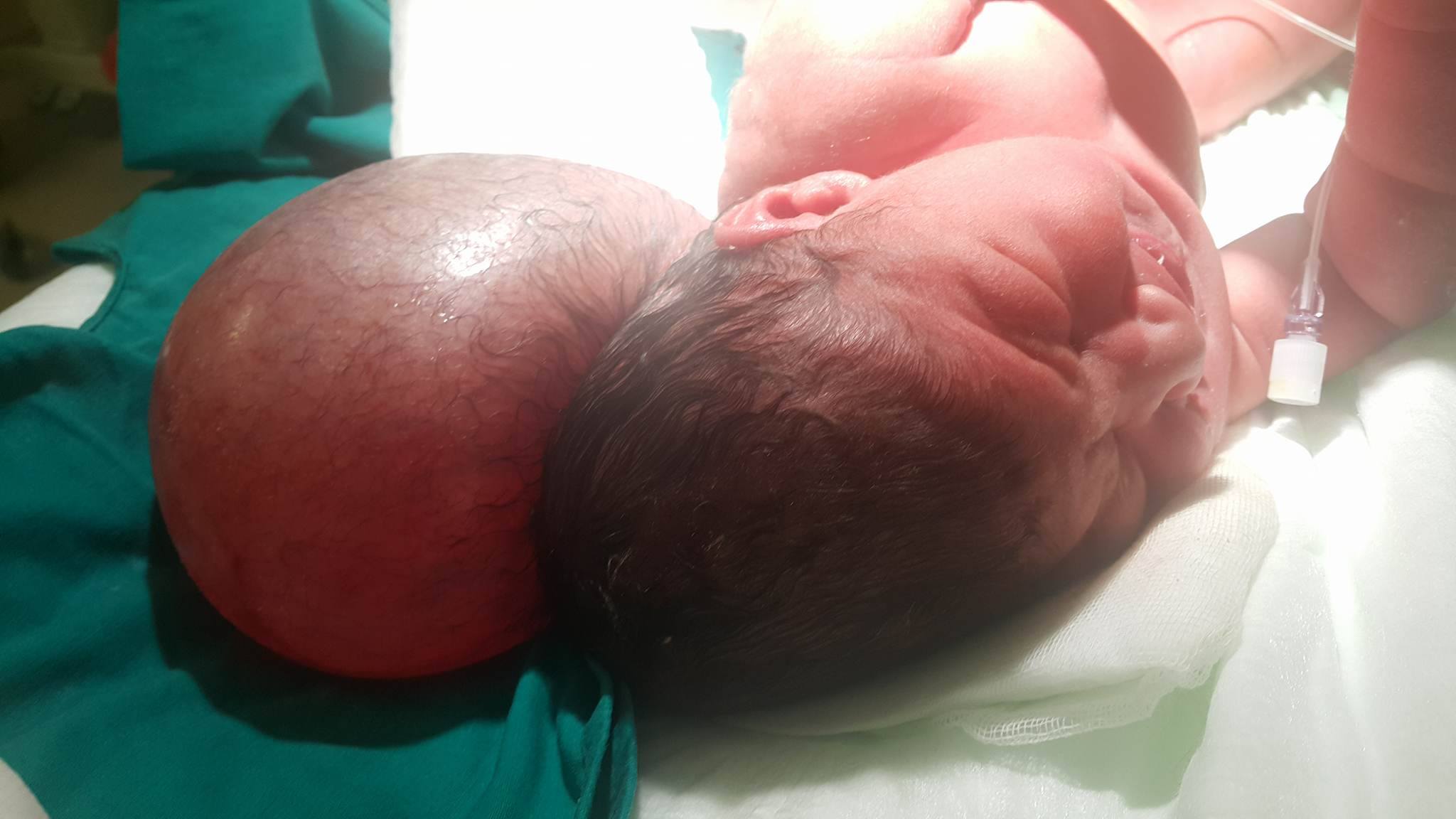 Ensefalosel (Sefalosel)