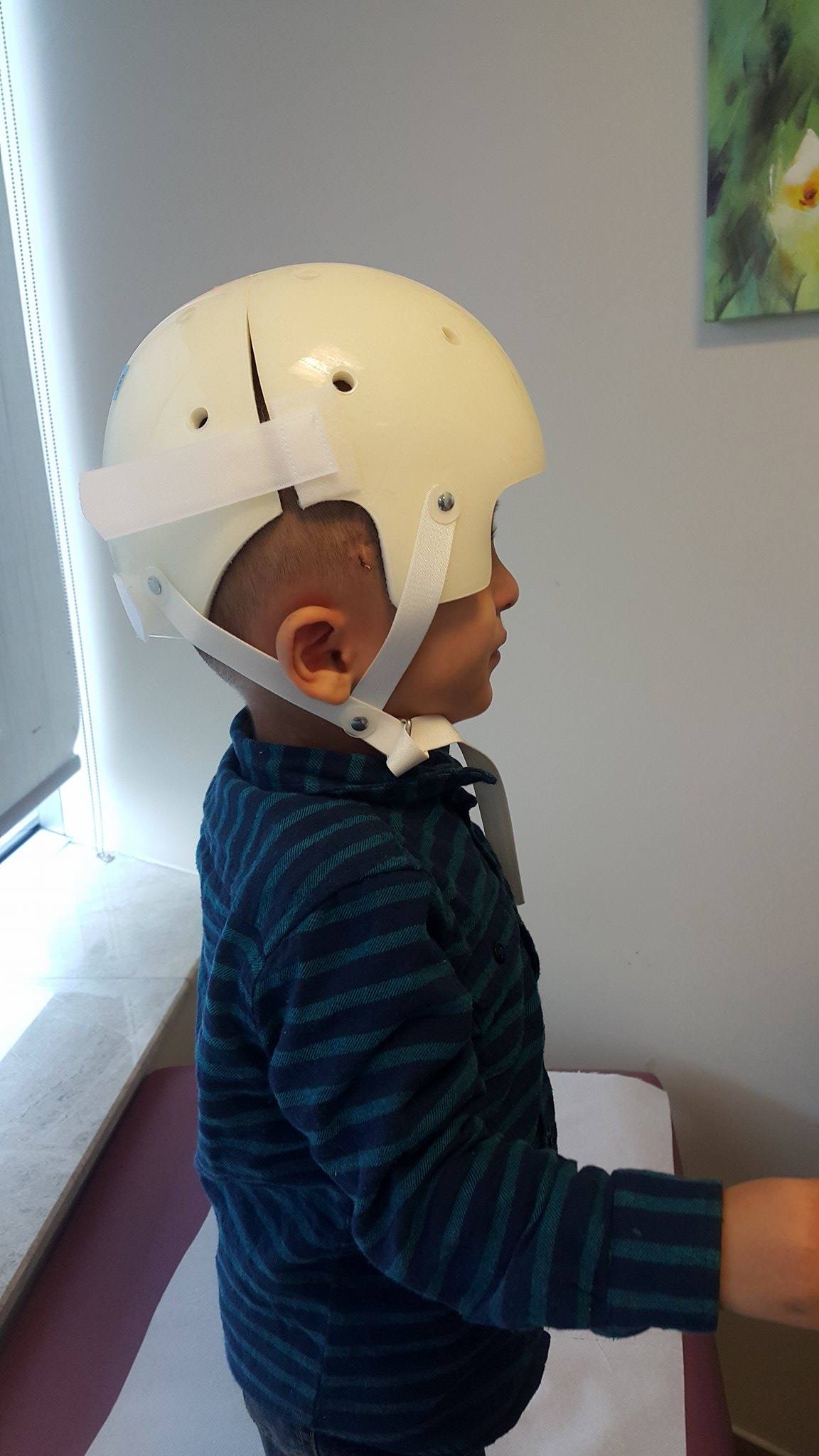 Kraniosinostoz ve Kask Tedavisi