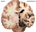 Alzheimer Hastalığı Kimlerde Görülür